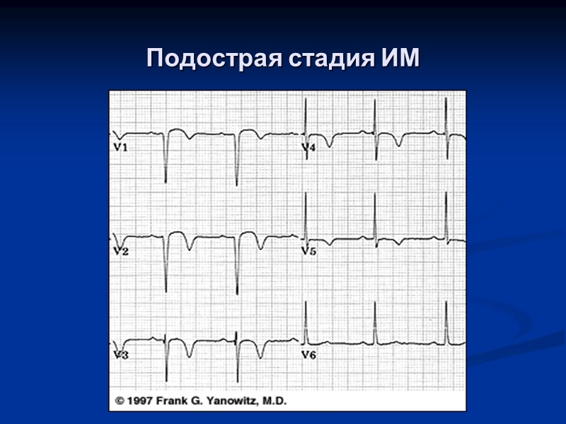 Подострая стадия ИМ